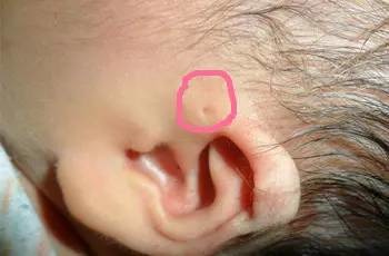 为什么宝宝耳朵旁边有个小洞?还会流脓