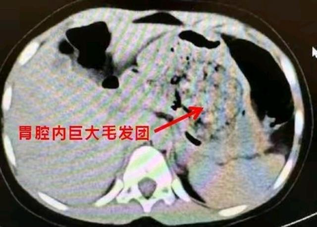 台州5岁女童患“长发公主综合征”腹痛就医惊现胃中发团